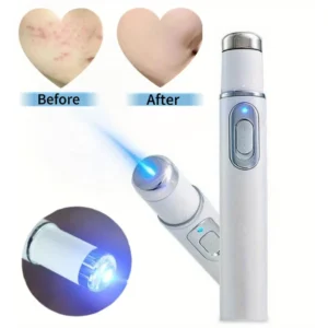 Portable Blue Light Acne Removal Pen – Sleek, Fragrance-Free Skin Therapy Tool