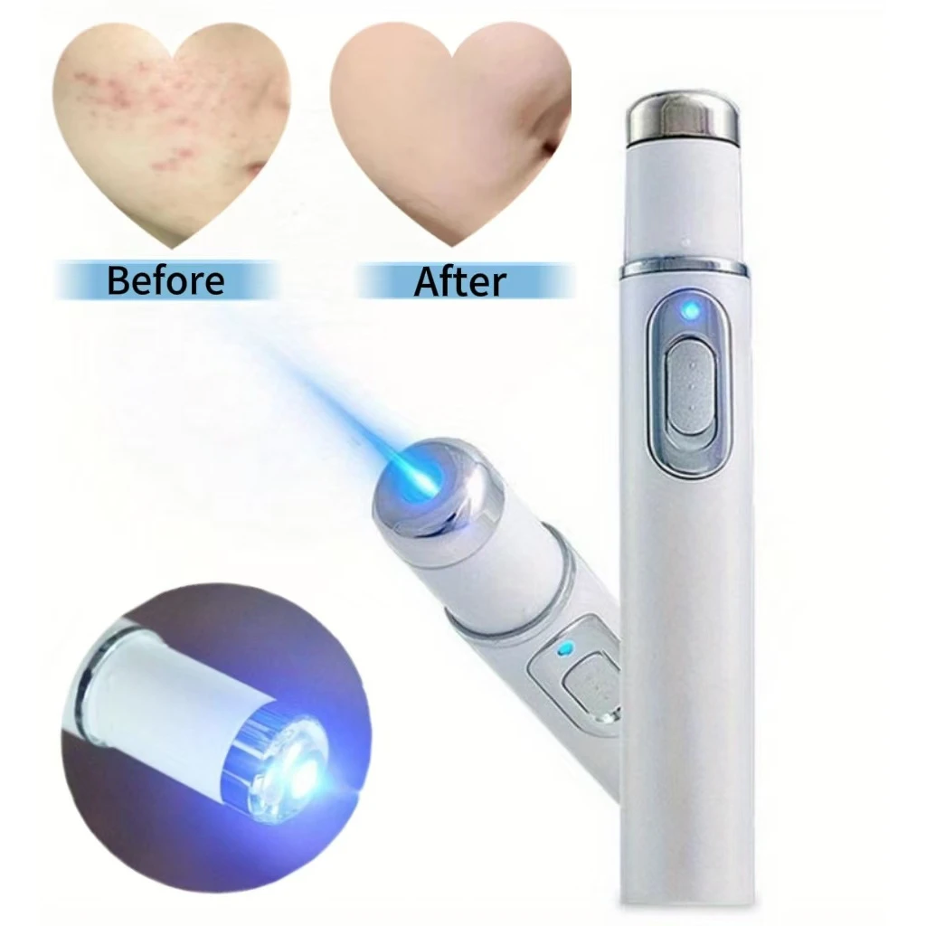 Portable Blue Light Acne Removal Pen – Sleek, Fragrance-Free Skin Therapy Tool